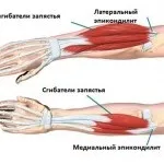 Медіальний епікондиліт ліктьового суглоба лікування, фото (епікондиліт) Медіальний епікондиліт ліктьового суглоба лікування, фото