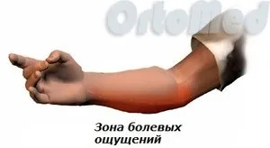 Медіальний епікондиліт ліктьового суглоба лікування, симптоми, фото, лікоть гольфіста (ліктьового) Медіальний епікондиліт ліктьового суглоба лікування, симптоми, фото, лікоть гольфіста