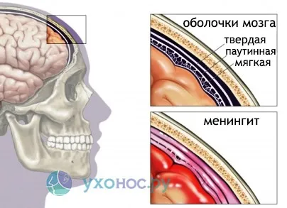 Менінгіт симптоми, ознаки, лікування у дітей, дорослих