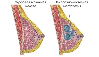 Мастопатія симптоми і ознаки, профілактика захворювання (захворювання) Мастопатія симптоми і ознаки, профілактика захворювання