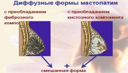 Мастопатія симптоми і ознаки, профілактика захворювання (профілактика) Мастопатія симптоми і ознаки, профілактика захворювання