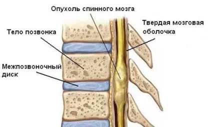 Менінгіома причини, симптоми, лікування, народні засоби, прогноз (причини) Менінгіома причини, симптоми, лікування, народні засоби, прогноз