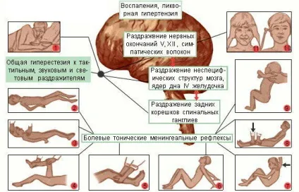 Менінгіт симптоми, ознаки, лікування у дітей, дорослих