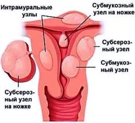 Міоматозний вузол на передній стінці матки (матки) Міоматозний вузол на передній стінці матки