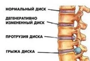 Міжхребцевий остеохондроз симптоми, лікування, профілактика (лікування) Міжхребцевий остеохондроз симптоми, лікування, профілактика