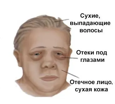Мікседема - причини, ознаки, симптоми і лікування (мікседема щитовидна залоза причини симптоми діагностика лікування народні методи профілактика) Мікседема - причини, ознаки, симптоми і лікування