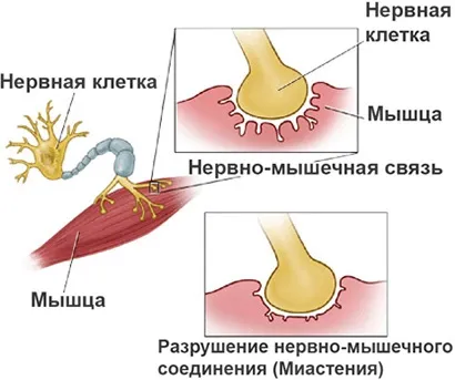 Міастенія гравіс (gravis) причини виникнення, симптоми і лікування антибіотиками генералізованої (виникнення) Міастенія гравіс (gravis) причини виникнення, симптоми і лікування антибіотиками генералізованої