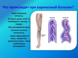 Народні засоби для лікування зірочок на ногах (судинних зірочок ногах) Народні засоби для лікування зірочок на ногах