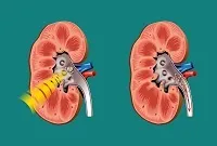 Брак кальцію в організмі симптоми, і як підвищити кальцій (кальцію) Брак кальцію в організмі симптоми, і як підвищити кальцій