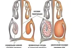 Не минає закладеність носа що робити (проходить закладеність носа) Не минає закладеність носа що робити