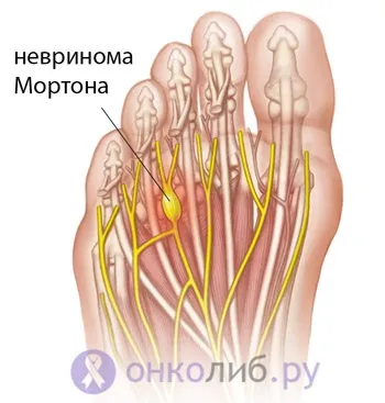 Неврома Мортона (стопи) лікування, симптоми, видалення (лікування) Неврома Мортона (стопи) лікування, симптоми, видалення