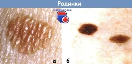Невус прикордонний - клініка, діагностика, прогноз (діагностика) Невус прикордонний - клініка, діагностика, прогноз