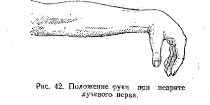 Неврит променевого нерва руки симптоми і лікування запалення