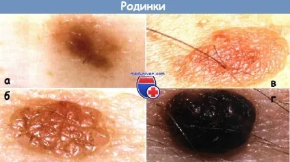 Невус прикордонний - клініка, діагностика, прогноз (прикордонний невус) Невус прикордонний - клініка, діагностика, прогноз