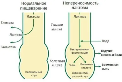 Непереносимість лактози у немовлят причини, діагностика, лікування (непереносимість лактози у немовлят симптоми ознаки аналіз лікування як визначити проявляється тест новонароджених причини дієта) Непереносимість лактози у немовлят причини, діагностика, лікування