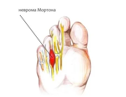 Неврома Мортона - симптоми, лікування (невріома) Неврома Мортона - симптоми, лікування