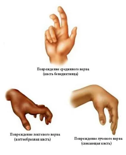 Неврит променевого нерва руки симптоми і лікування запалення