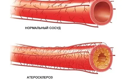 Обширний інсульт наслідки і шанси вижити (наслідки) Обширний інсульт наслідки і шанси вижити