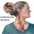 Операція при остеохондрозі показання та протипоказання (остеохондрозі) Операція при остеохондрозі показання і протипоказання