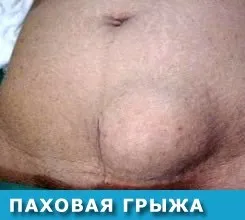 Чи небезпечна біль справа внизу живота в чоловіки (праворуч) Чи небезпечна біль справа внизу живота у чоловіка