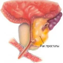 Онкологія статевих органів жінок і чоловіків, рак - лікування і профілактика