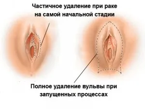 Онкологія статевих органів жінок і чоловіків, рак - лікування і профілактика