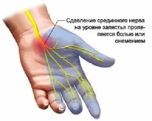 Оніміння великого пальця лівої (пальця) Оніміння великого пальця лівої