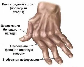 Опухають суглоби на пальцях рук причини, методи лікування (опухають) Опухають суглоби на пальцях рук причини, методи лікування