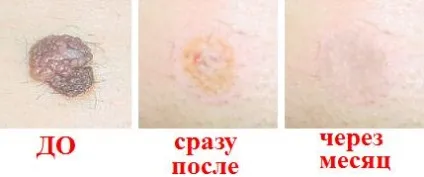 Небезпечні родимки ознаки, як визначити злоякісну родимку та чи треба видаляти родимки (визначити) Небезпечні родимки ознаки, як визначити злоякісну родимку і чи треба видаляти родимки