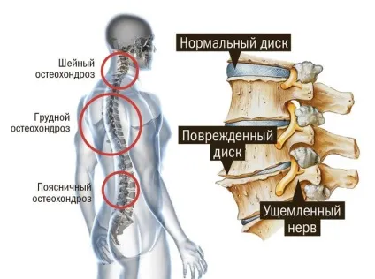 Операція при остеохондрозі показання і протипоказання (показання) Операція при остеохондрозі показання і протипоказання