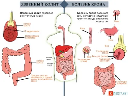 Чи небезпечна біль справа внизу живота у чоловіка (внизу) Чи небезпечна біль справа внизу живота у чоловіка