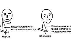 Ортопедична подушка при кривошиї для новонароджених