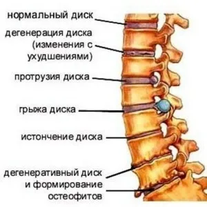 Основні симптоми шийного остеохондрозу (Через здавлювання нервових) Основні симптоми шийного остеохондрозу