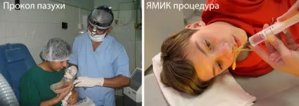 Гострий риносинусит що це таке, симптоми і лікування (симптоми) Гострий риносинусит що це таке, симптоми і лікування