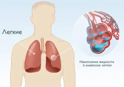 Набряк легенів причин і симптоми захворювання (набряк) Набряк легень причини і симптоми захворювання