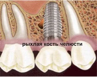 Пародонтоз причини виникнення у дорослих спадковість, інфекції
