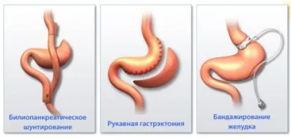 Ожиріння - причини, симптоми, діагностика та лікування (ожиріння переїдання маса тіло весвісцеральний абдомінальне гіноідное) Ожиріння - причини, симптоми, діагностика та лікування