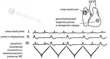 Парасистолія ознаки, на ЕКГ, лікування, шлуночкова і передсердна (лікування) Парасистолія ознаки, на ЕКГ, лікування, шлуночкова і передсердна