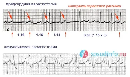 Парасистолія ознаки, на ЕКГ, лікування, шлуночкова і передсердна (лікування) Парасистолія ознаки, на ЕКГ, лікування, шлуночкова і передсердна