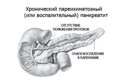 Паренхіматозний панкреатит види, прогноз, симптоми, лікування (симптоми) Паренхіматозний панкреатит види, прогноз, симптоми, лікування