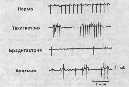 парез шлунка
