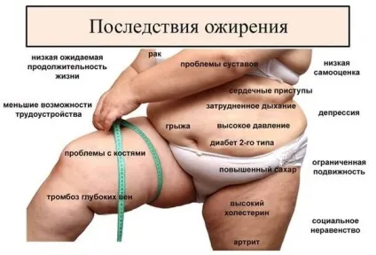 Ожиріння - види, стадії та ускладнення захворювання (захворювання) Ожиріння - види, стадії та ускладнення захворювання