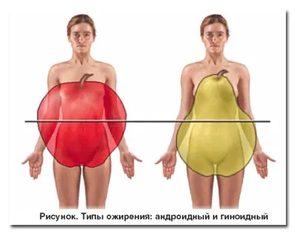 Ожиріння - причини, симптоми, діагностика та лікування (лікування) Ожиріння - причини, симптоми, діагностика та лікування