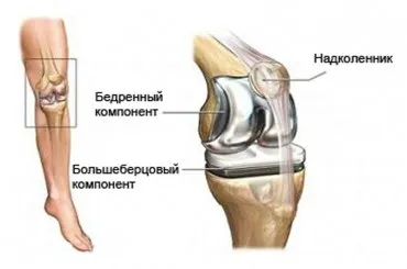 Первинне ендопротезування, центр остеопорозу