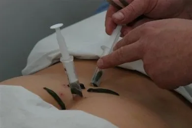 П'явки і целюліт
