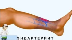 Чому болять пальці на ногах причини і лікування (ногах) Чому болять пальці на ногах причини і лікування