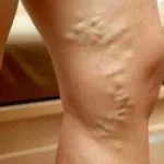 Чому вночі ноги судомить причини і лікування (судомою) Чому вночі ноги судомить причини і лікування