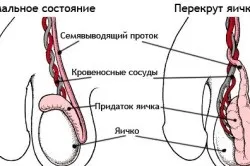 Чому яєчка піднімаються вгору патологія це або норма (піднімаються) Чому яєчка піднімаються вгору патологія це або норма