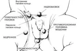 Чому яєчка піднімаються вгору патологія це або норма (вгору) Чому яєчка піднімаються вгору патологія це або норма