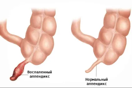 Чому підвищується температура і болить живіт у дитини (болить) Чому підвищується температура і болить живіт у дитини